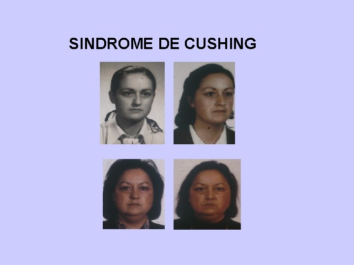 SINDROME DE CUSHING 