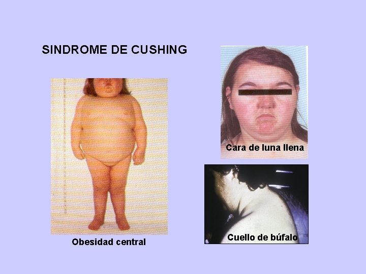 SINDROME DE CUSHING Cara de luna llena Obesidad central Cuello de búfalo 