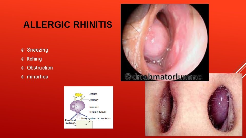 ALLERGIC RHINITIS Sneezing Itching Obstruction rhinorhea 