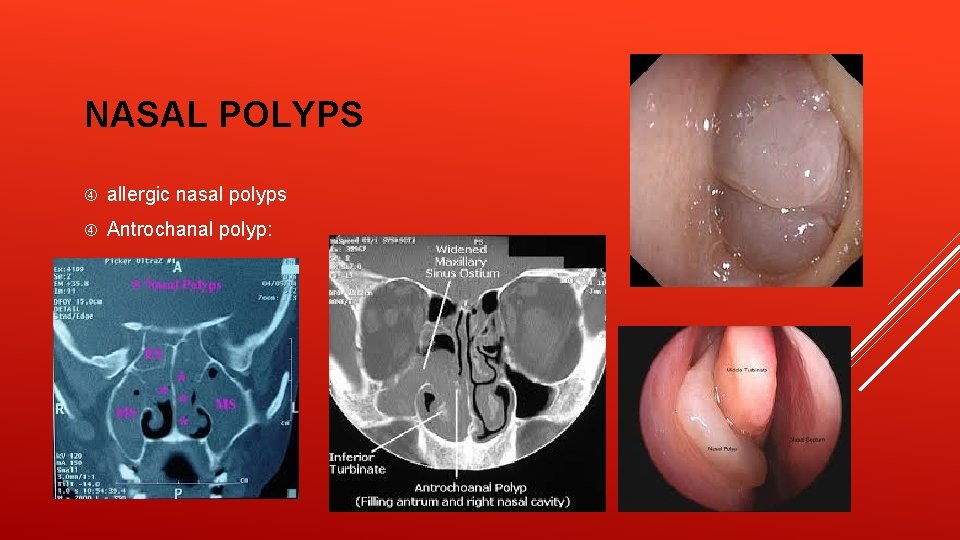 NASAL POLYPS allergic nasal polyps Antrochanal polyp: 
