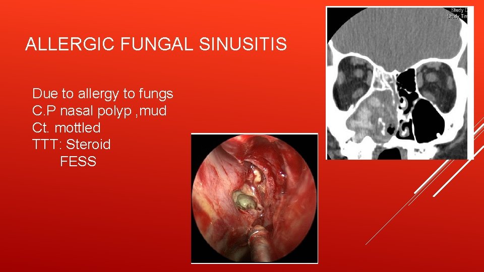 ALLERGIC FUNGAL SINUSITIS Due to allergy to fungs C. P nasal polyp , mud