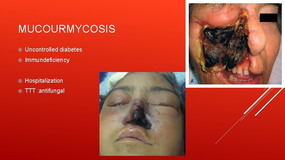 MUCOURMYCOSIS Uncontrolled diabetes Immundeficiency Hospitalization TTT : antifungal 