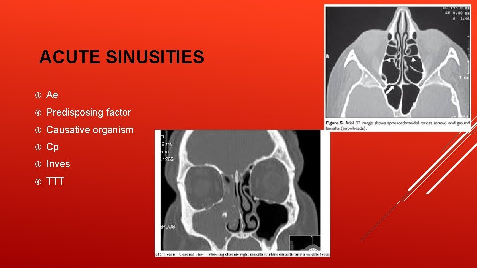 ACUTE SINUSITIES Ae Predisposing factor Causative organism Cp Inves TTT 