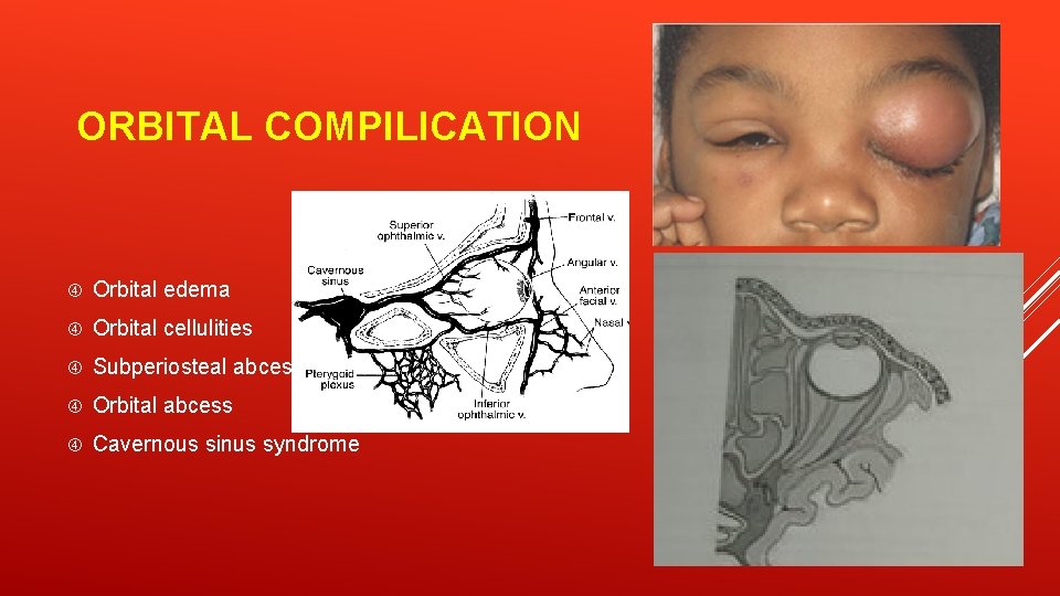 ORBITAL COMPILICATION Orbital edema Orbital cellulities Subperiosteal abcess Orbital abcess Cavernous sinus syndrome 