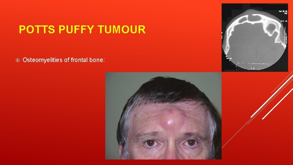 POTTS PUFFY TUMOUR Osteomyelities of frontal bone: 