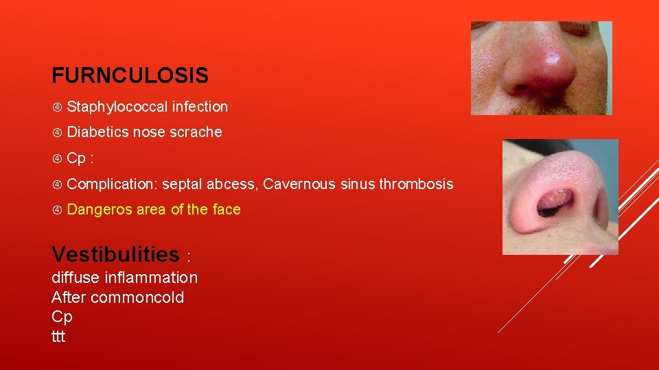 FURNCULOSIS Staphylococcal infection Diabetics nose scrache Cp : Complication: septal abcess, Cavernous sinus thrombosis