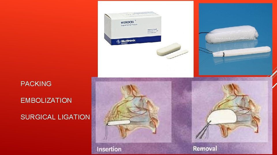 PACKING EMBOLIZATION SURGICAL LIGATION 