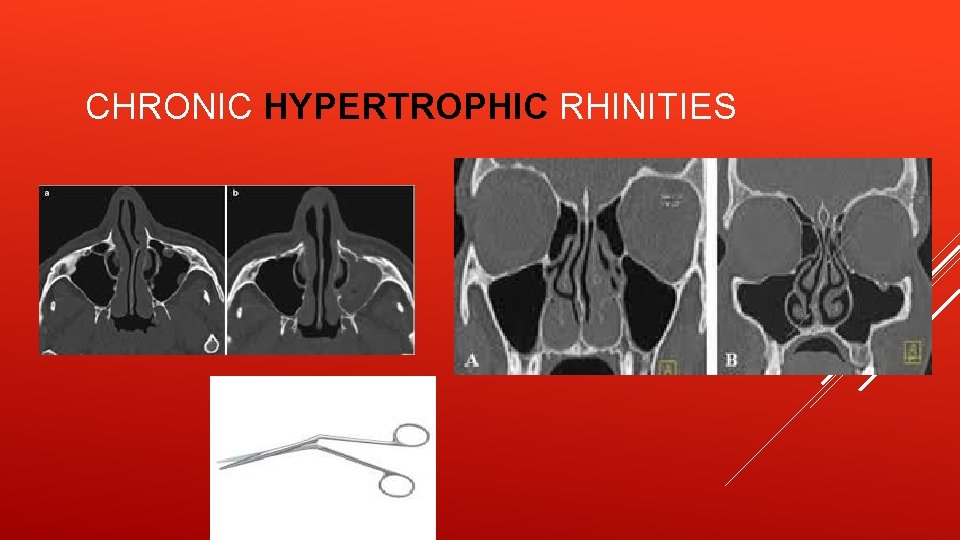 CHRONIC HYPERTROPHIC RHINITIES 