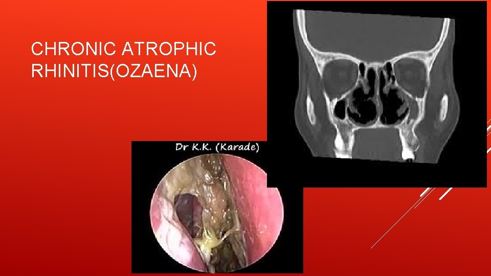 CHRONIC ATROPHIC RHINITIS(OZAENA) 