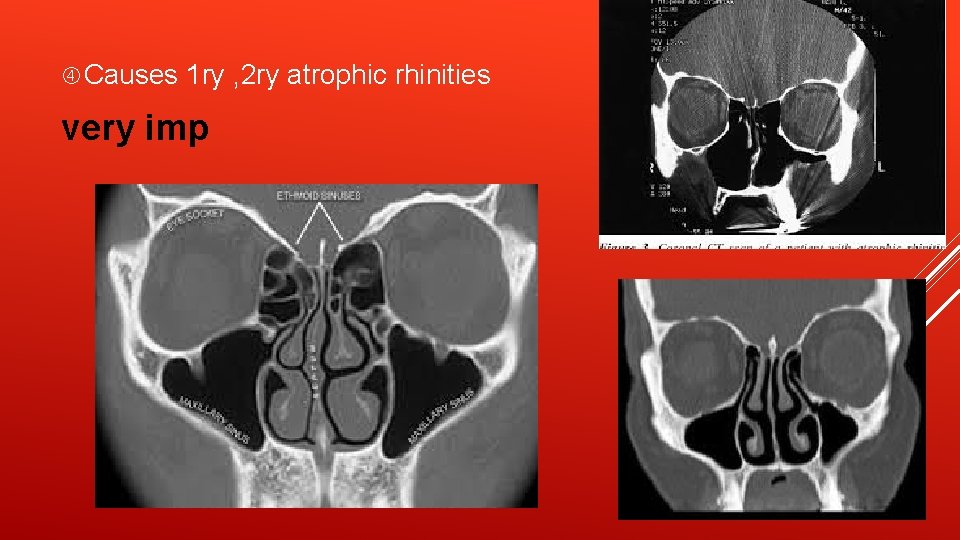  Causes 1 ry , 2 ry atrophic rhinities very imp 