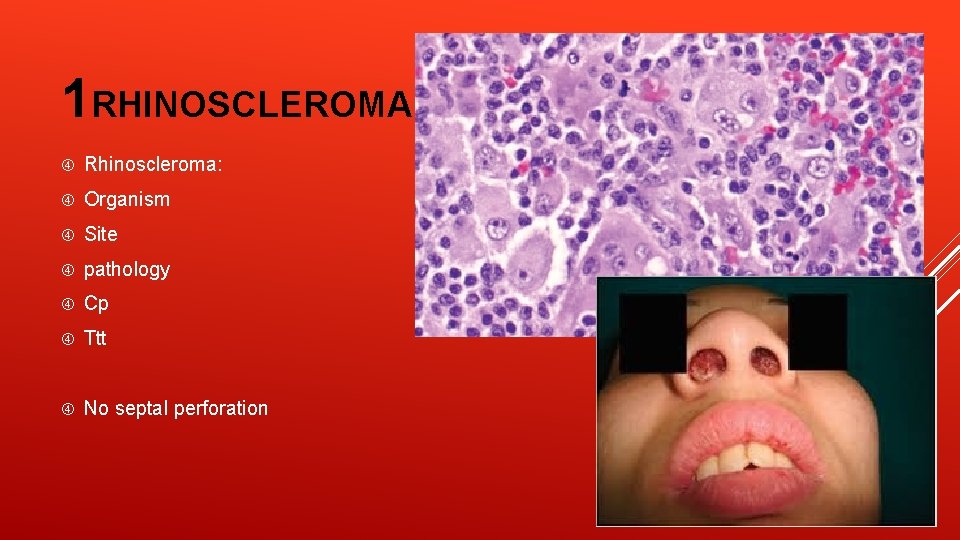 1 RHINOSCLEROMA Rhinoscleroma: Organism Site pathology Cp Ttt No septal perforation 
