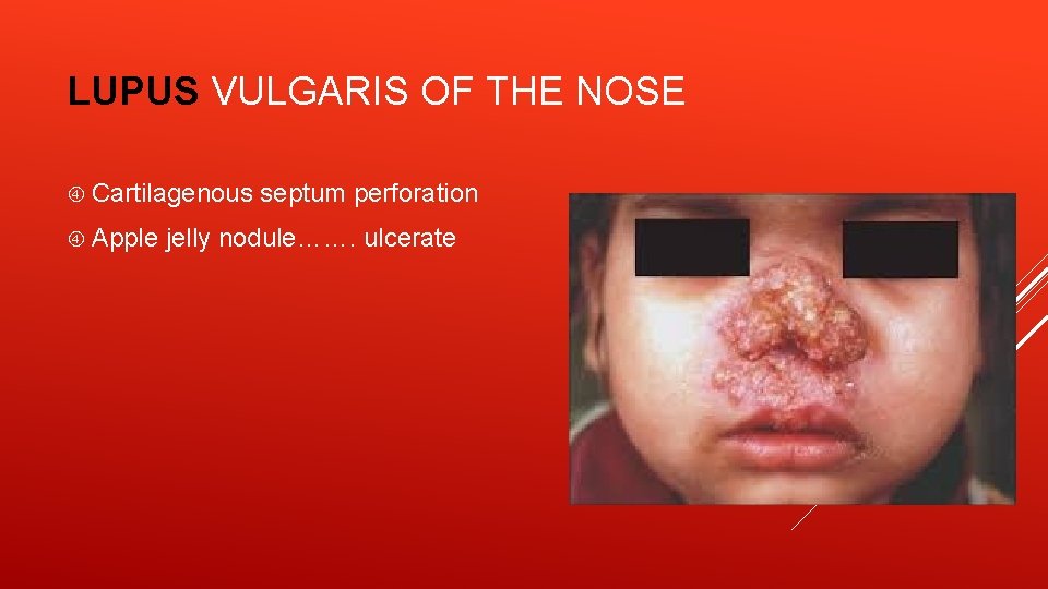 LUPUS VULGARIS OF THE NOSE Cartilagenous Apple septum perforation jelly nodule……. ulcerate 