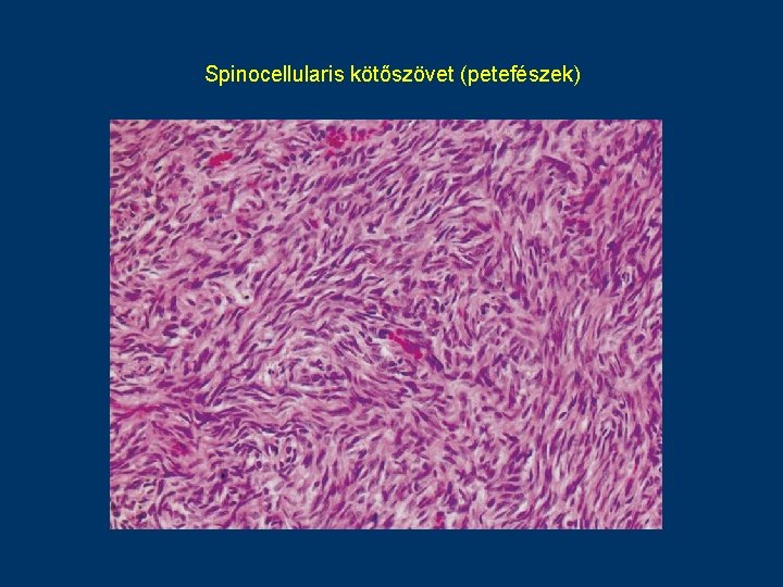 Spinocellularis kötőszövet (petefészek) 