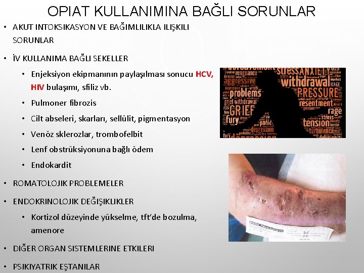 OPIAT KULLANIMINA BAĞLI SORUNLAR • AKUT INTOKSIKASYON VE BAĞIMLILIKLA ILIŞKILI SORUNLAR • İV KULLANIMA OPIAT KULLANIMINA BAĞLI SORUNLAR • AKUT INTOKSIKASYON VE BAĞIMLILIKLA ILIŞKILI SORUNLAR • İV KULLANIMA