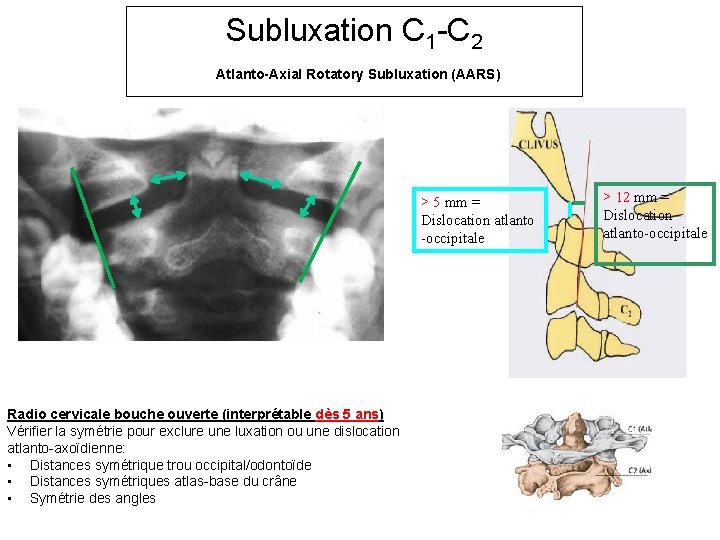 Subluxation C 1 -C 2 Atlanto-Axial Rotatory Subluxation (AARS) > 5 mm = Dislocation