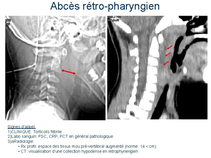 Abcès rétro-pharyngien Signes d’appel: 1)CLINIQUE: Torticolis fébrile 2)Labo sanguin: FSC, CRP, PCT en général