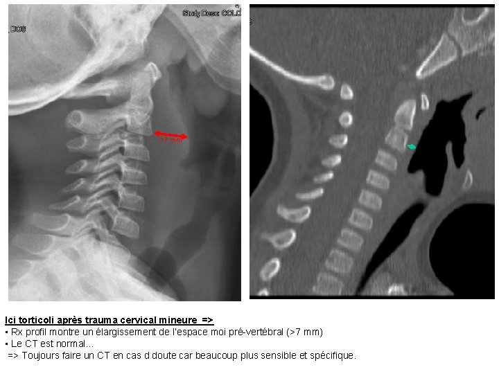 >7 mm Ici torticoli après trauma cervical mineure => • Rx profil montre un