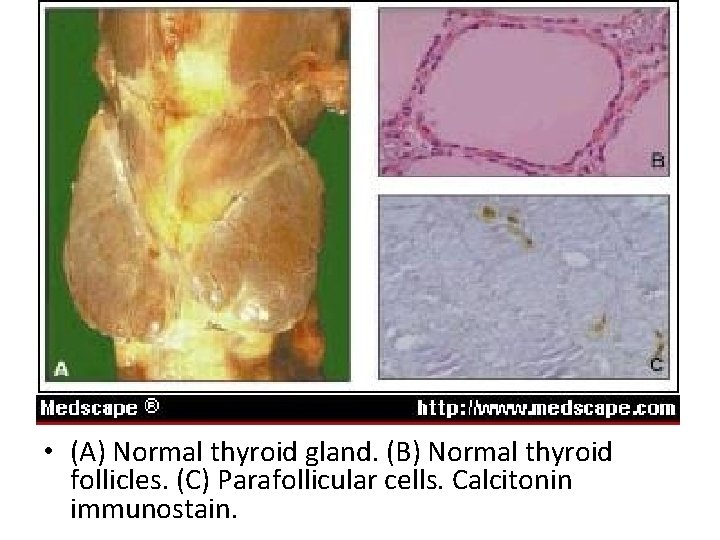  • (A) Normal thyroid gland. (B) Normal thyroid follicles. (C) Parafollicular cells. Calcitonin