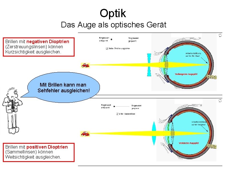 Optik Das Auge als optisches Gerät Brillen mit negativen Dioptrien (Zerstreuungslinsen) können Kurzsichtigkeit ausgleichen.