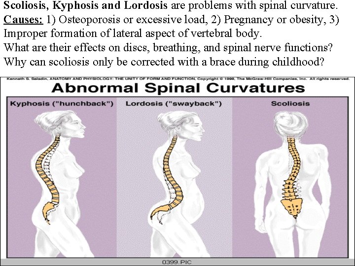 Scoliosis, Kyphosis and Lordosis are problems with spinal curvature. Causes: 1) Osteoporosis or excessive