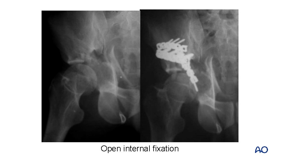 Open internal fixation 