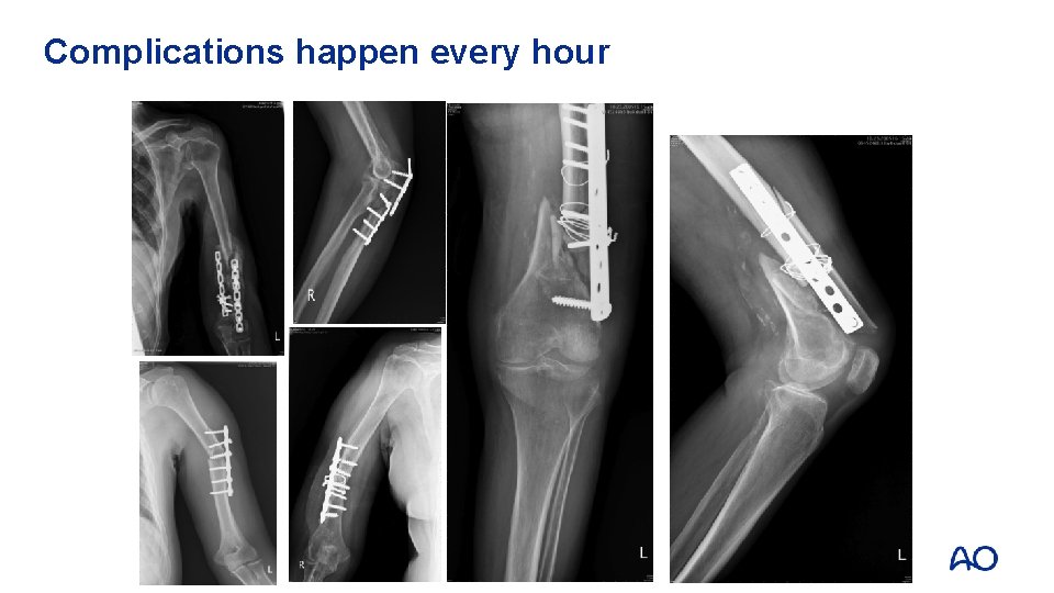 Complications happen every hour 