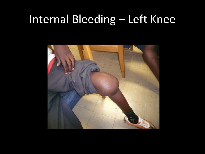 Internal Bleeding – Left Knee 