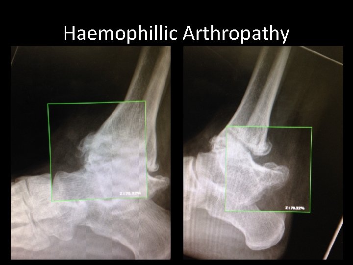 Haemophillic Arthropathy 