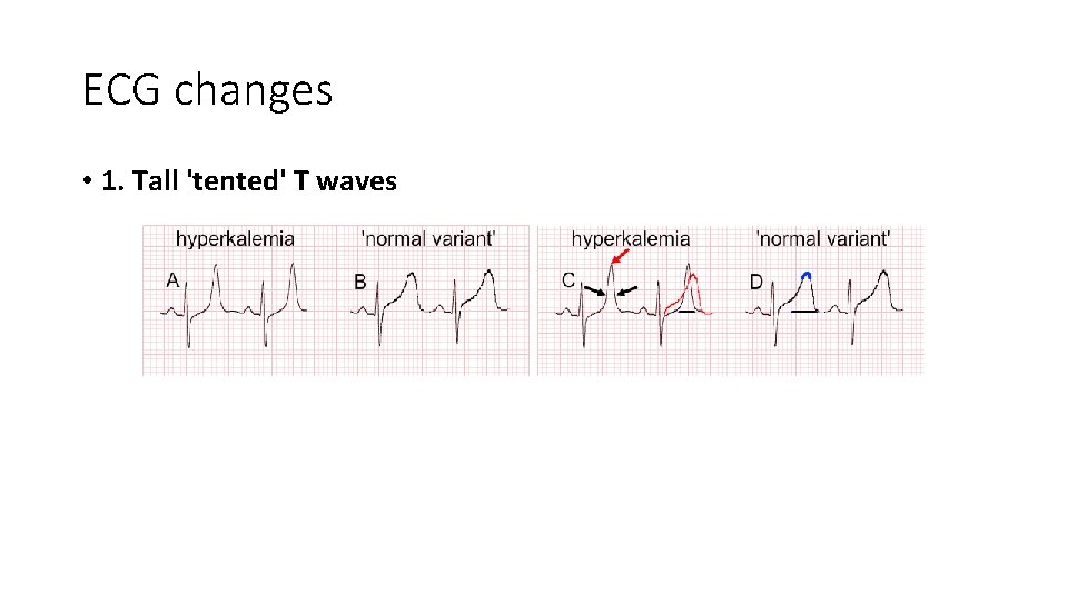 ECG changes • 1. Tall 'tented' T waves 