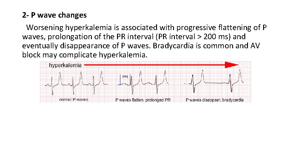 2 - P wave changes Worsening hyperkalemia is associated with progressive flattening of P