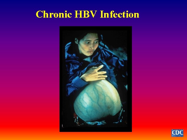 Chronic HBV Infection 