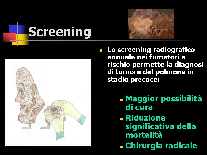 Screening n Lo screening radiografico annuale nei fumatori a rischio permette la diagnosi di