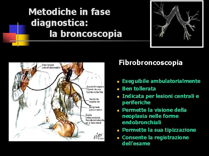 Metodiche in fase diagnostica: la broncoscopia Fibrobroncoscopia n n n Eseguibile ambulatorialmente Ben tollerata