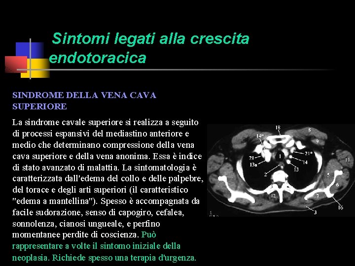 Sintomi legati alla crescita endotoracica SINDROME DELLA VENA CAVA SUPERIORE La sindrome cavale superiore