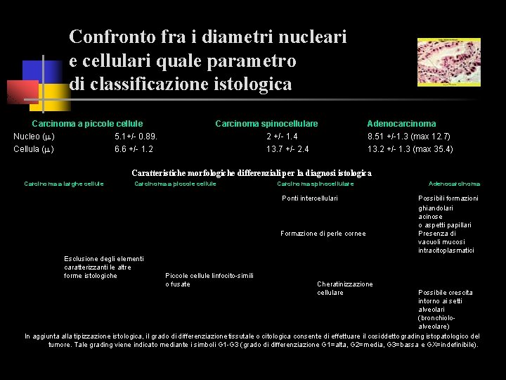 Confronto fra i diametri nucleari e cellulari quale parametro di classificazione istologica Carcinoma a