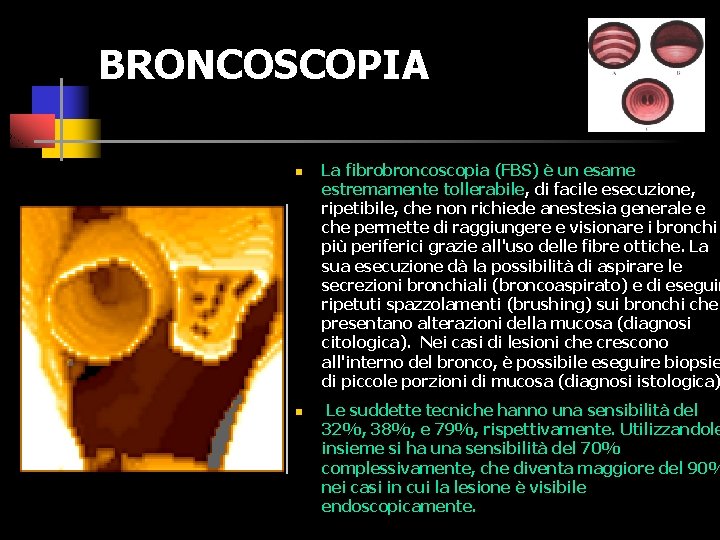 BRONCOSCOPIA n n La fibrobroncoscopia (FBS) è un esame estremamente tollerabile, di facile esecuzione,