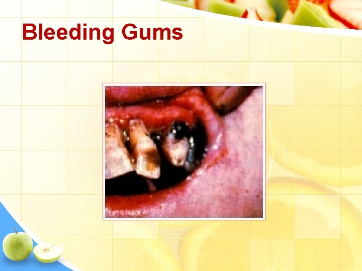 Bleeding Gums 