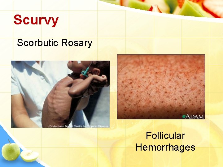 Scurvy Scorbutic Rosary Follicular Hemorrhages 
