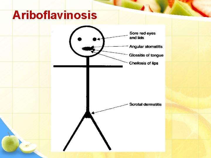 Ariboflavinosis 