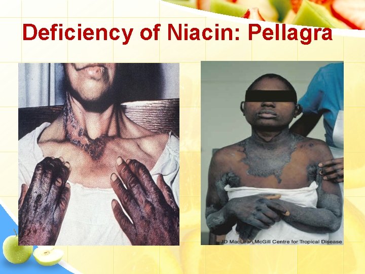 Deficiency of Niacin: Pellagra 