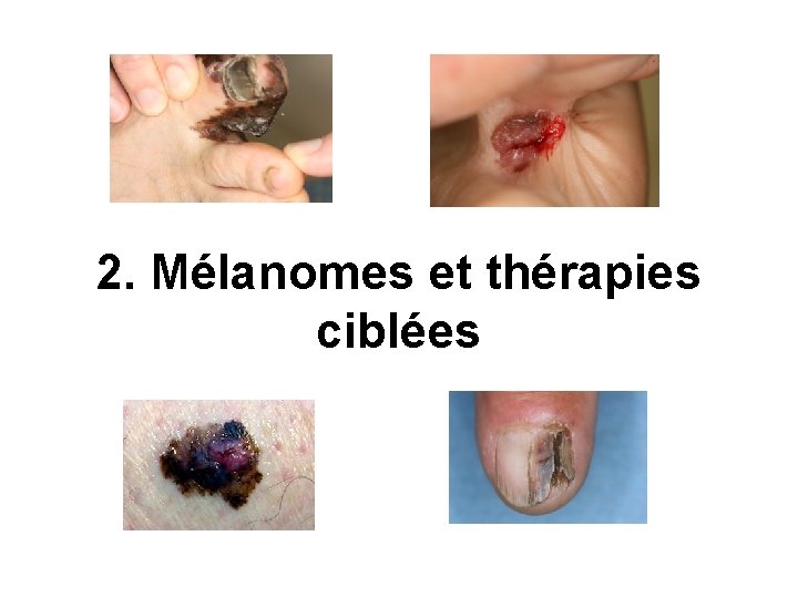 2. Mélanomes et thérapies ciblées 