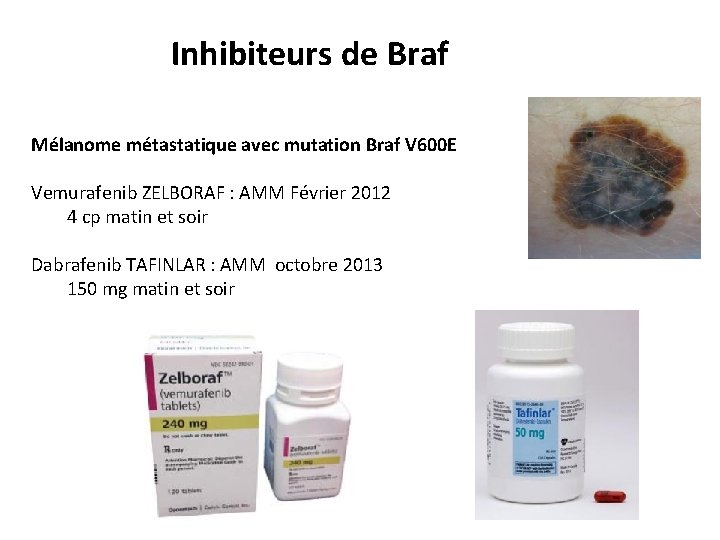 Inhibiteurs de Braf Mélanome métastatique avec mutation Braf V 600 E Vemurafenib ZELBORAF :