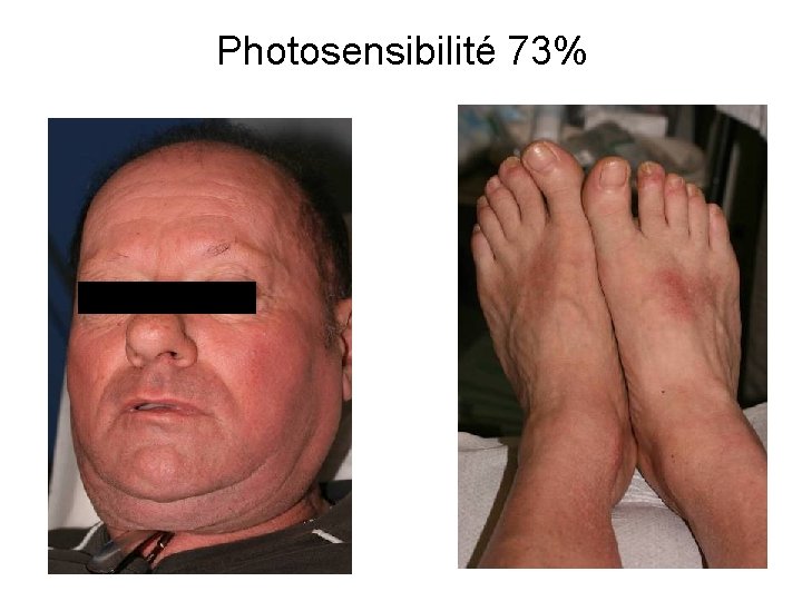 Photosensibilité 73% 
