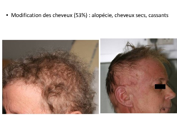  • Modification des cheveux (53%) : alopécie, cheveux secs, cassants 