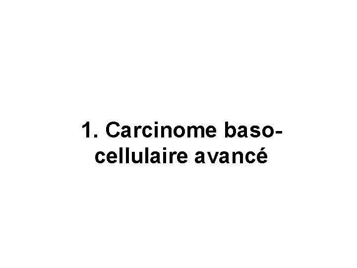 1. Carcinome basocellulaire avancé 