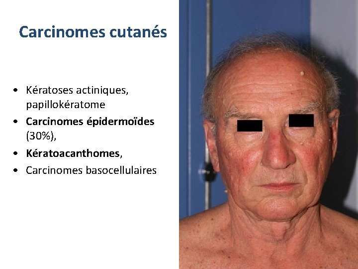 Carcinomes cutanés • Kératoses actiniques, papillokératome • Carcinomes épidermoïdes (30%), • Kératoacanthomes, • Carcinomes
