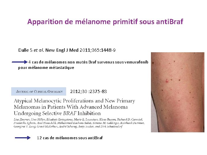 Apparition de mélanome primitif sous anti. Braf Dalle S et al. New Engl J