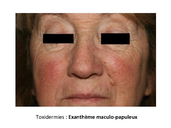 Toxidermies : Exanthème maculo-papuleux 