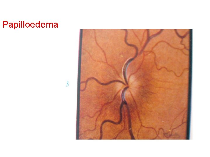 Papilloedema Papilloedema
