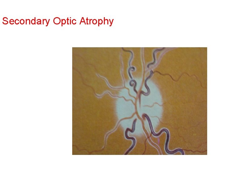 Secondary Optic Atrophy Secondary Optic Atrophy
